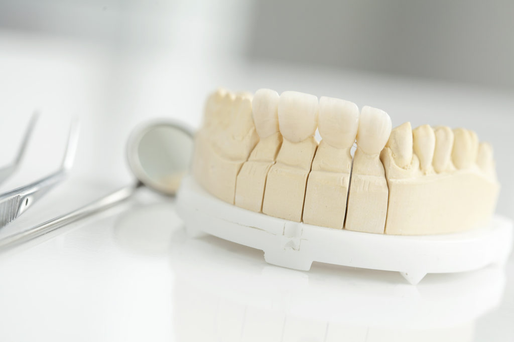 Ceramic bridge on plaster model